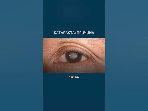 Главная причина катаракты. - YouTube
