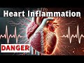 Heart Inflammation &amp; Scar Tissue = Electrical DANGER