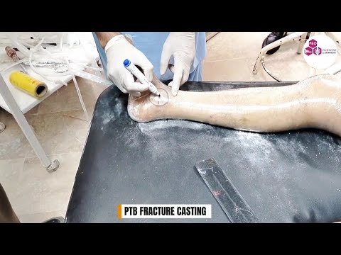PTB Fracture Brace Casting | Complete Guide for Tibial Fracture Management | Orthotic Application