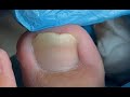 How to cut ingrown toenail by Chinese troditional method