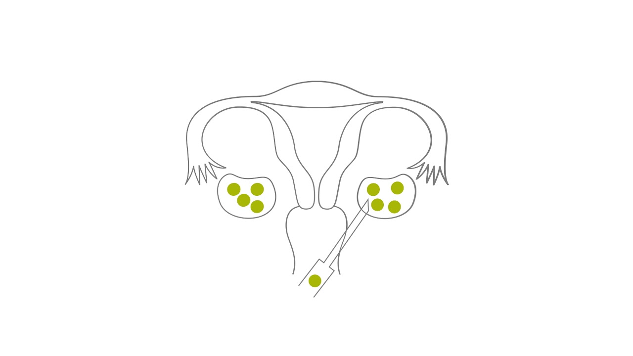 Egg Freezing Orientation - Canada Olive Fertility Clinic - YouTube