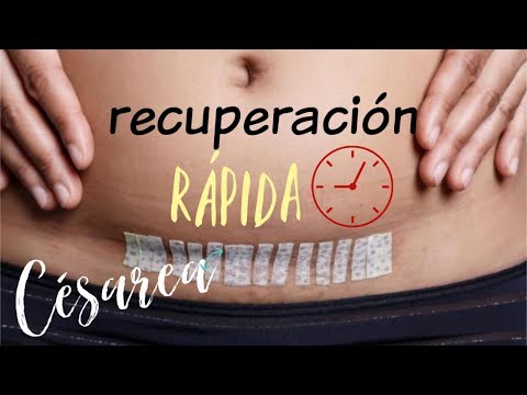Tiempo de recuperacion por cesarea