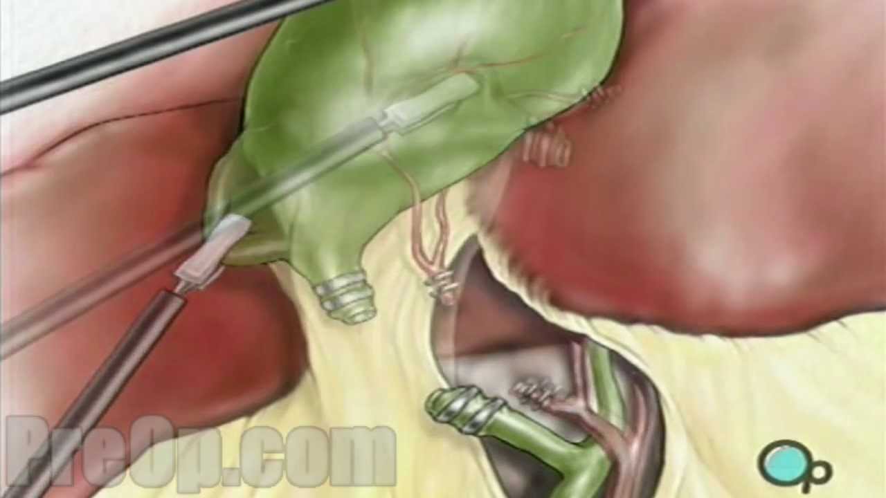 Illustration depicting cholecystectomy, the surgical removal of the  gallbladder.