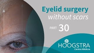Eyelid surgery without scars - Part 30
