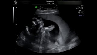 ‘Disability abortions’ targeted in Florida House bill