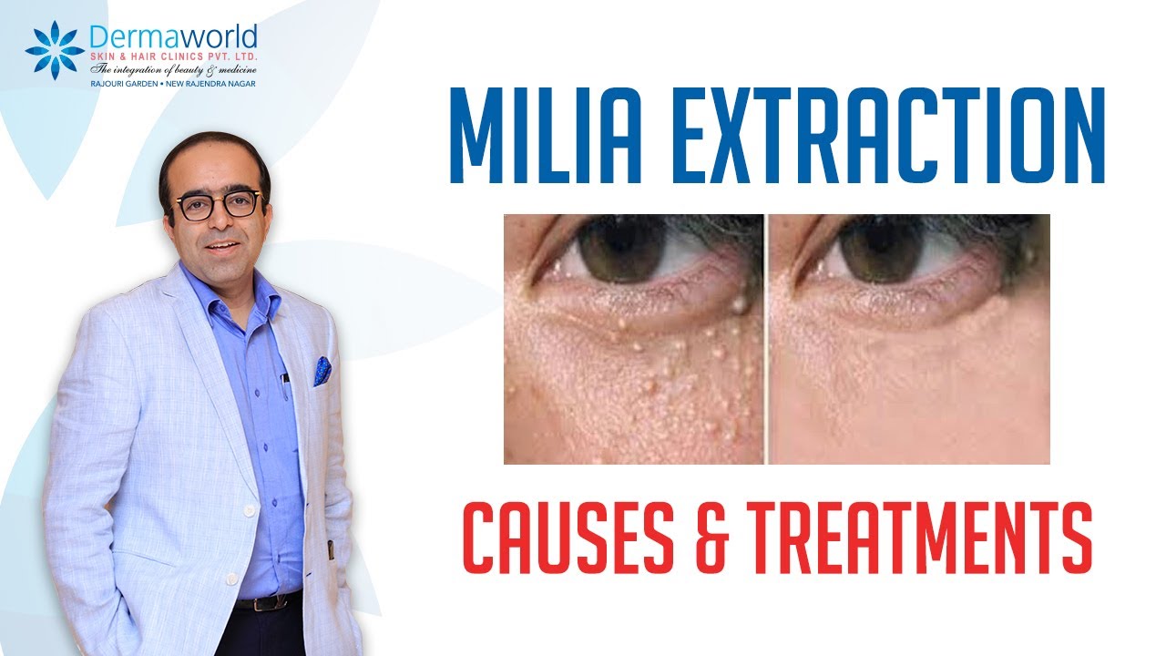 Eyes treatment under milia home WHY DO