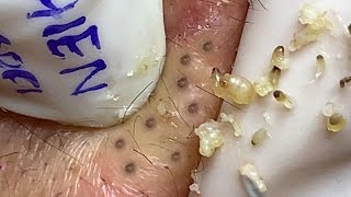 BLACKHEADS AND CYSTIC ACNE REMOVAL ON MAN'S FACE #031