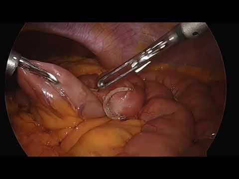 Total Laparoscopic Choledochal cyst excision & Roux-en-Y hepaticojejunostomy