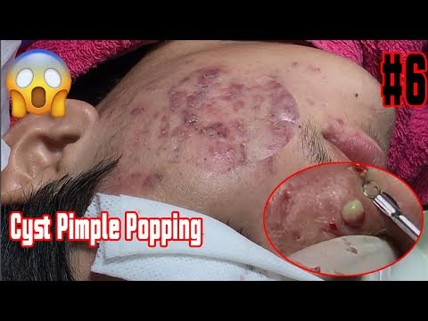 Cystic Acne on the cheeks Blackheads & Whitehead Removal Cyst Pimple Popping | Part