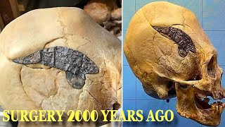 '2000 Year Old Surgery' Warrior Skull Held Together By Metal Plate by Patryn 6,983 views 2 years ago 2 minutes