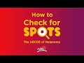 How to check for spots the abcde of melanoma