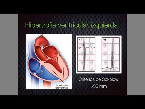 EKG patológico 3: Hipertrofia, infarto y más