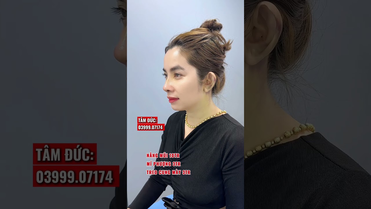 THAY ĐỔI DÁNG MŨI THAY ĐỔI CẢ GƯƠNG MẶT