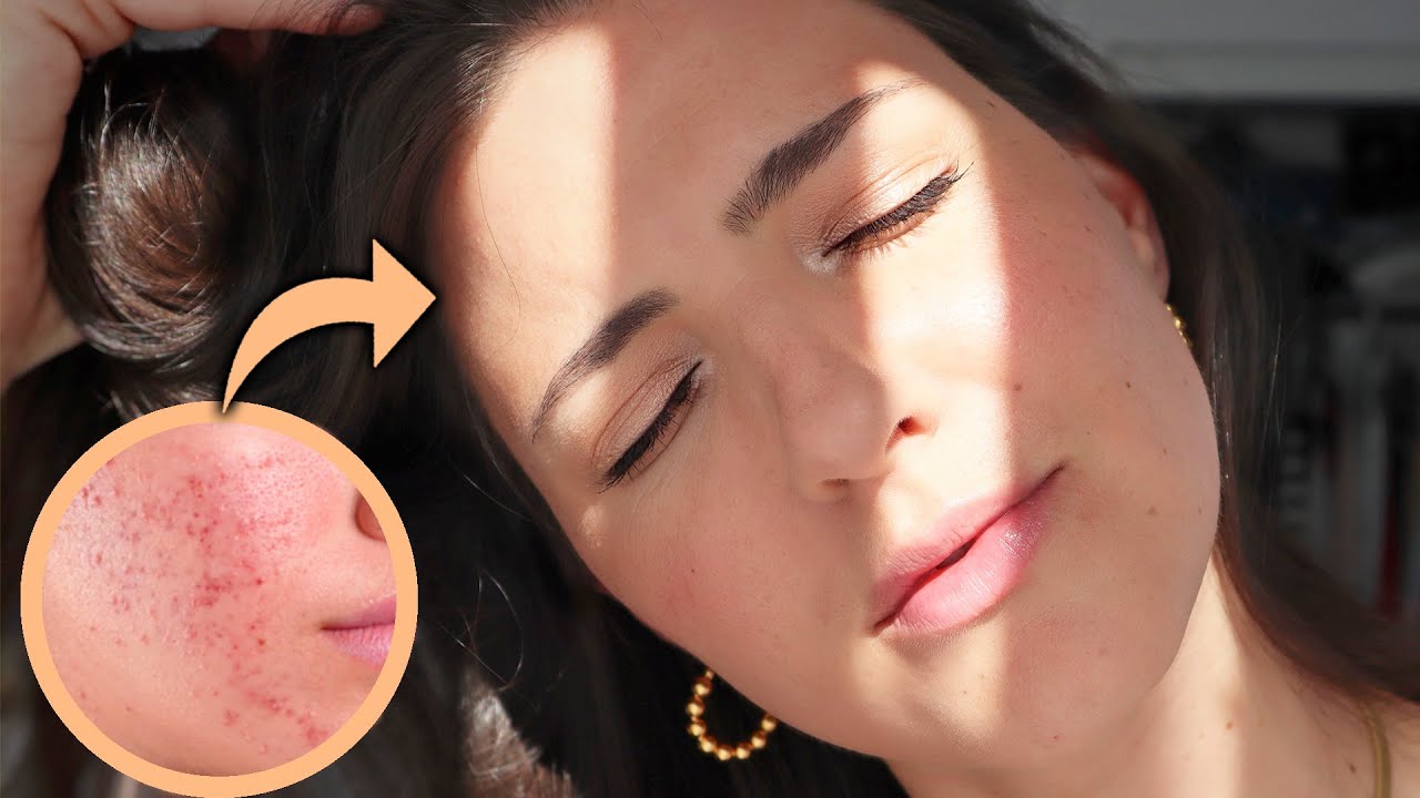 3 TIPS FOR CLEAR SKIN | how I got rid of my acne (naturally) - YouTube