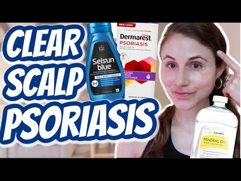 How to CLEAR SCALP PSORIASIS| Dr Dray