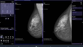 syngo via VB10 MG Breast   Printing (  Máy in vú MG) screenshot 1