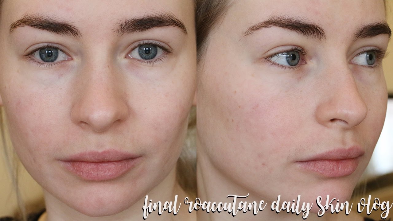 Roaccutane Roaccutane