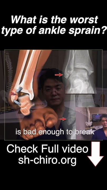 what-happens-if-you-have-the-worst-type-of-ankle-sprain-shanghai