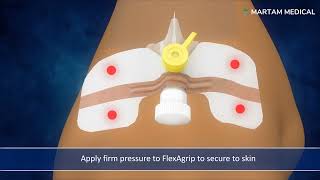 FlexAgrip Catheter Securement  Application