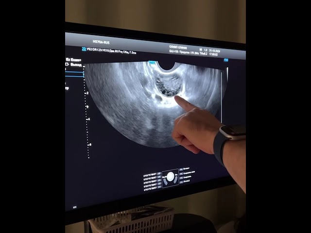 ПОЛИКИСТОЗНЫЕ ЯИЧНИКИ на УЗИ | Гинеколог Дмитрий Лубнин