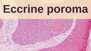 Eccrine Poroma - Pathology mini tutorial