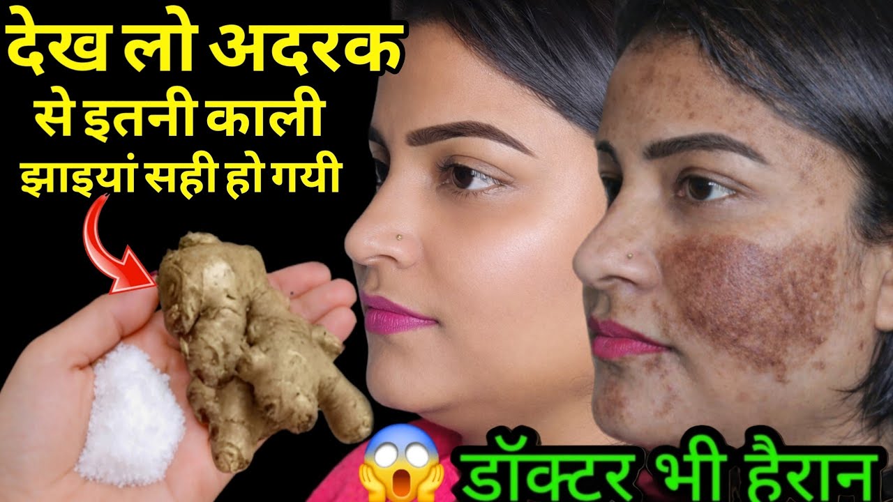 अदरक से झाइयां हटाने का कमाल का तरीका Reduce Melasma, Pigmentation, Discolouration Blackspots