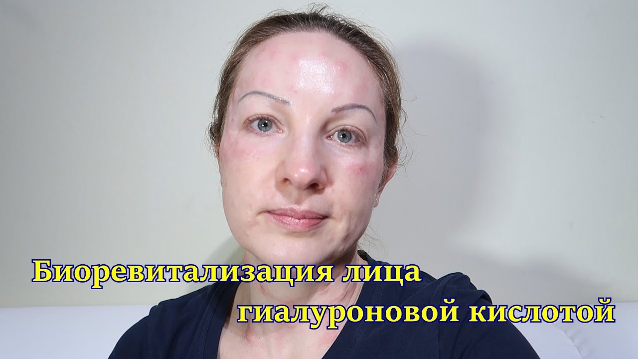 Биоревитализация лица гиалуроновой кислотой Биоревитализация лица гиалуроновой кислотой