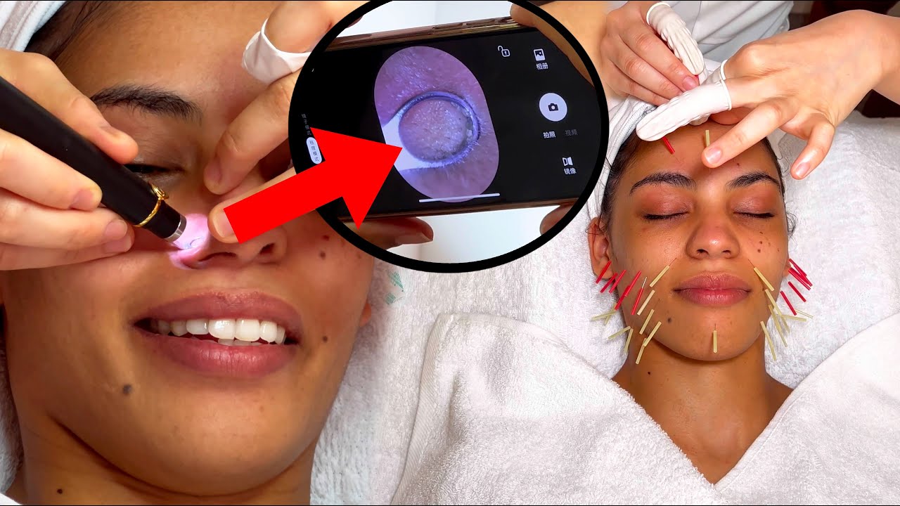 АСМР: Расслабляющая китайская акупунктура для лица с удалением прыщей!