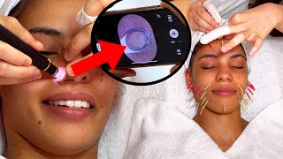ASMR: Relaxing Chinese Facial Acupuncture with ACNE Removal!