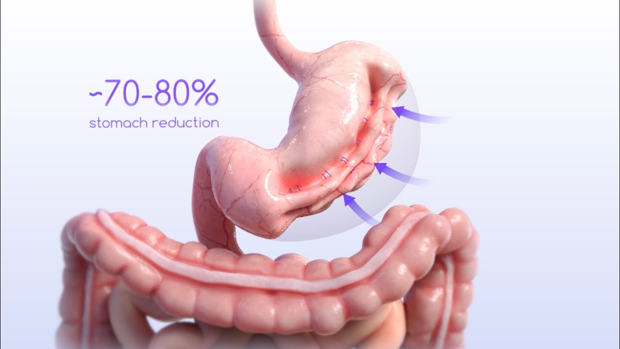 ESG Animation (Endoscopic Sleeve Gastroplasty) YouTube
