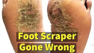 Foot Scraper Gone Wrong
