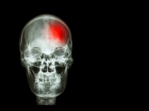 Vídeo: Fundamentos Genéticos De La Recuperación Después Del Accidente Cerebrovascular: Una Oportunidad Para El Descubrimiento De Genes, La Estratificación De Riesgos Y La Medicina De Prec