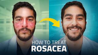 How To TREAT Rosacea in 2024 | Dermatologist