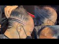 Lemonade Braids | Alopecia | Very Detailed - Part One