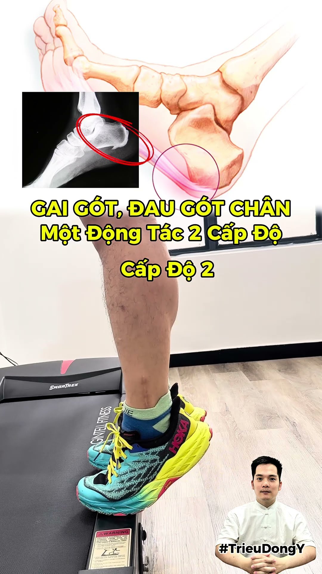 Heel spurs 👉 Heel pain, plantar fasciitis 👉 1 exercise, 2 levels 🇻🇳
