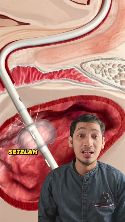 PEMASANGAN KATETER