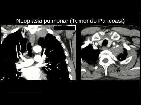 Vídeo: Tumor De Pancoast: Sintomas, Tratamento, Expectativa De Vida E Muito Mais