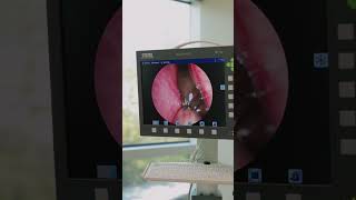 WHAT IS THAT?! #ent #entsurgery #hearingloss #nasalcongestion #sinusinfection #sinusitis #nose screenshot 5