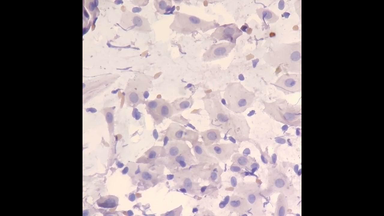 pap-smear-reactive-changes-youtube