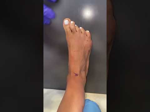 Video: Varför händer hallux valgus?