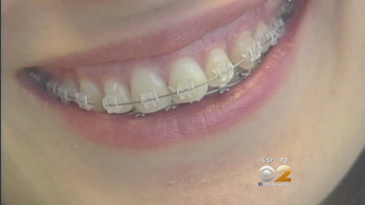 Adult Braces