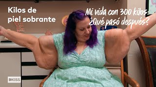 La realidad de tener kilos de piel sobrante | Mi vida con 300 kilos: ¿Qué pasó después