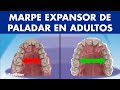 MARPE EXPANSOR de PALADAR - Así funciona el disyuntor de ortodoncia en adultos ©