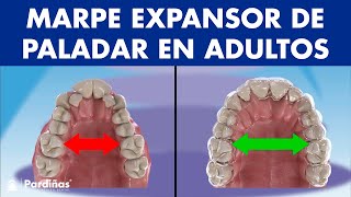 MARPE EXPANSOR de PALADAR  Así funciona el disyuntor de ortodoncia en adultos ©