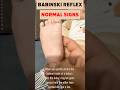 Babinski Reflex: Normal Signs in Child #medical #pregnancy  #baby #babyshorts
