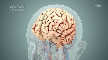생로병사의 비밀 - 급성 뇌졸중. 20170906