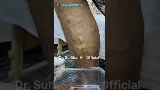 varicose vein Treatment #venipuncture #varicoseveinstreatment #varicosevein #drsulfikarali screenshot 5