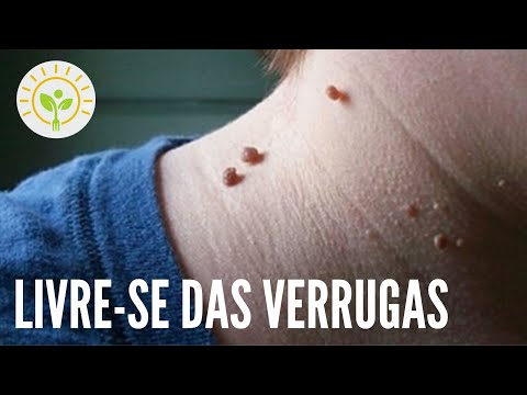 A RELAÇÃO ENTRE VERRUGAS E IMUNIDADE | APRENDA NUTRIÇÃO