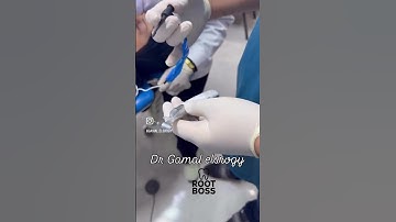 Dual Function in Endodontics | Endo Motor + Apex Locator Advantage