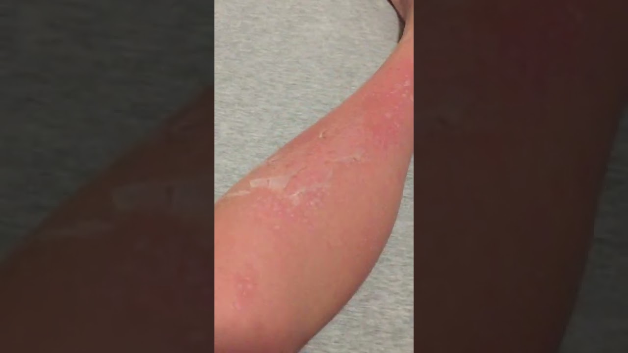 Skin Peeling from Sunburn #asmr